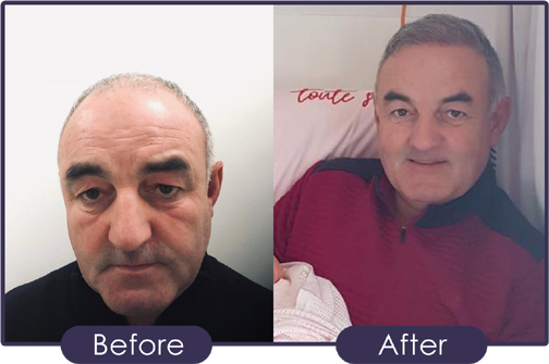 Hair Transplant Glasgow Before & After 2